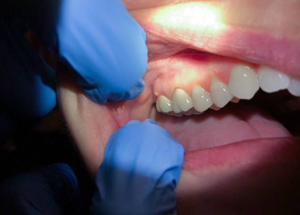 Best Emergency Tooth Extraction in Olympia Fields, IL